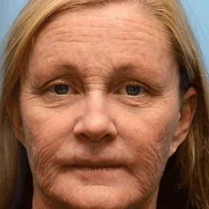 Pureluxo® Botox Bee Venom Wrinkle Removal Cream