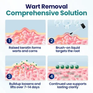 Tiworld™ Wart Lift Wart Removal Liquid