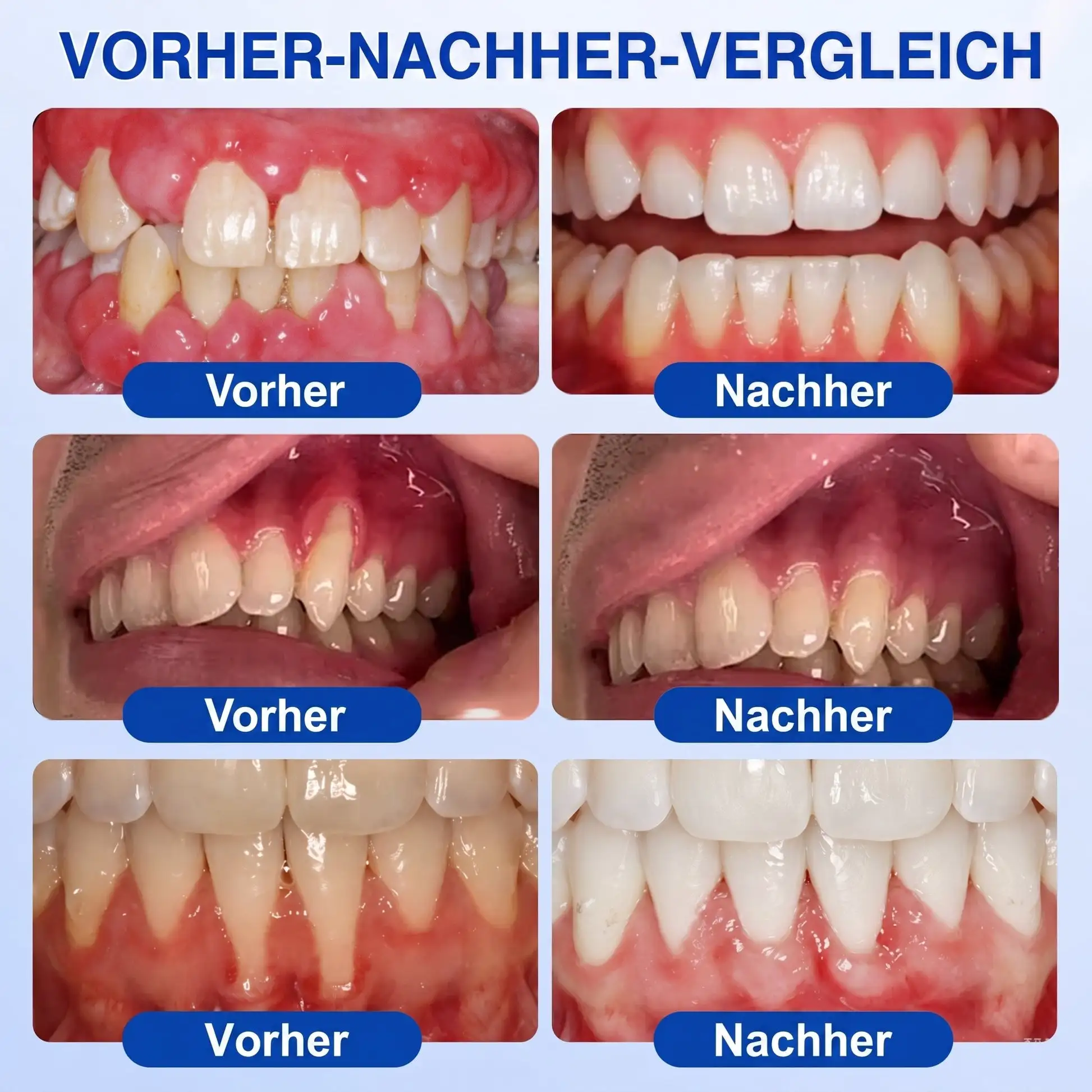 Keyess® GumRevive Zahnfleisch- Regenerationsgel 