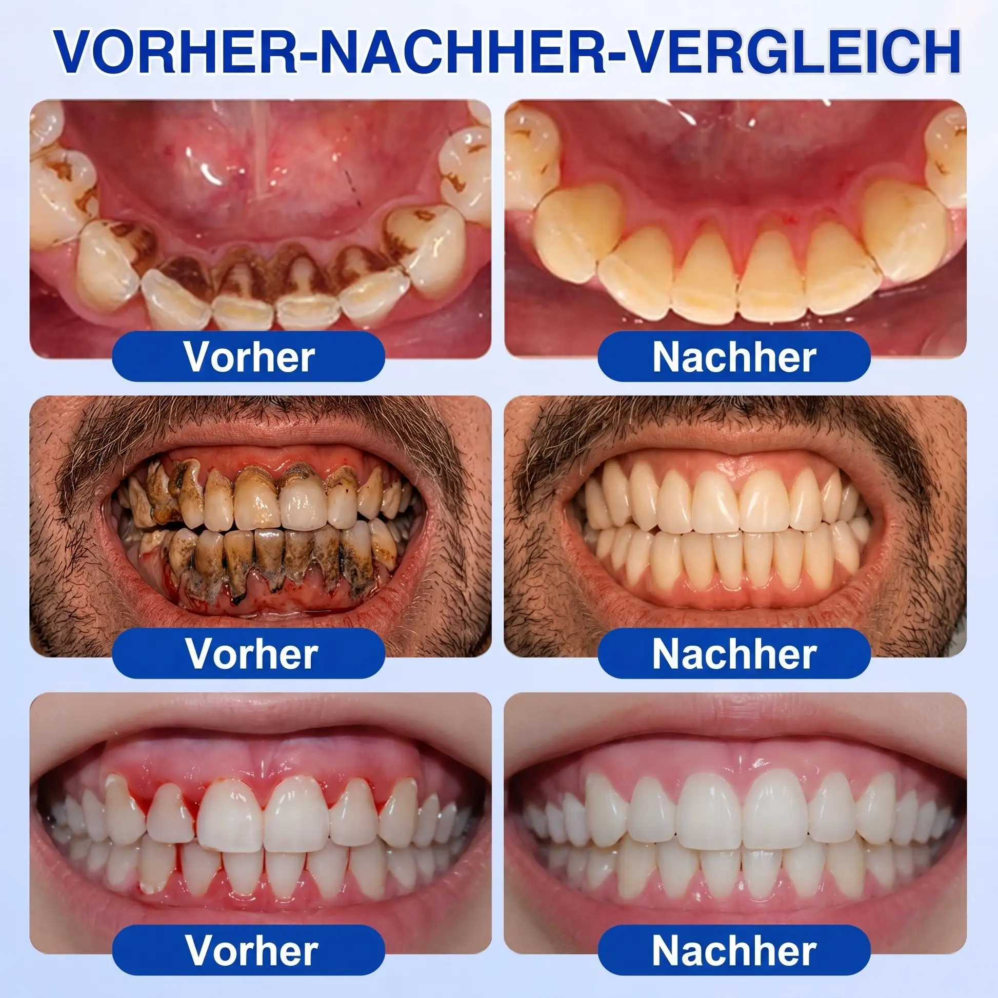 Keyess® GumRevive Zahnfleisch- Regenerationsgel 